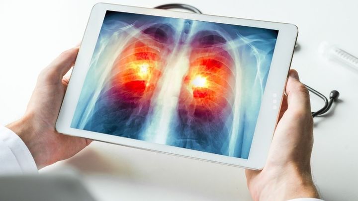 Investigación sobre cáncer de pulmón / Redacción