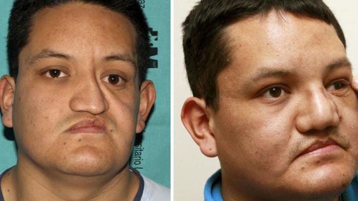 Primera reconstrucción de rosto con prótesis cerámica / CAM